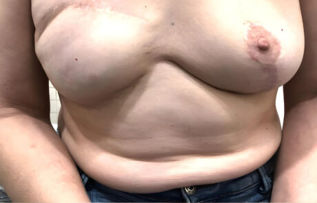 Tatuaje reconstructivo en Mataró